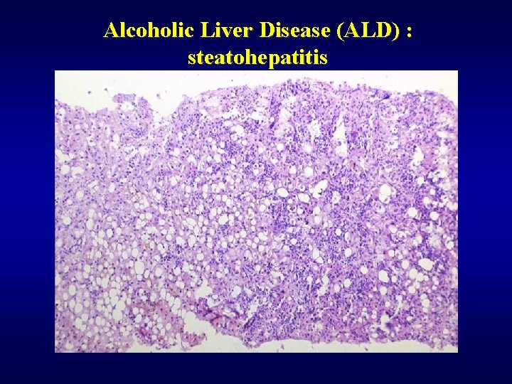 Alcoholic Liver Disease (ALD) : steatohepatitis 