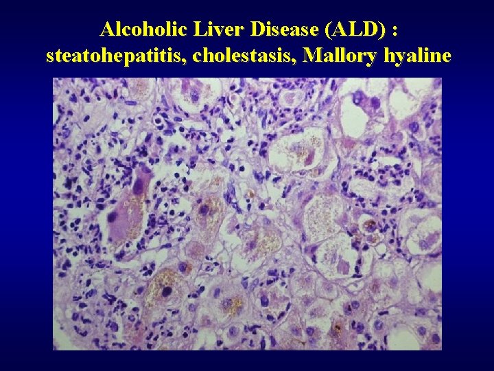 Alcoholic Liver Disease (ALD) : steatohepatitis, cholestasis, Mallory hyaline 