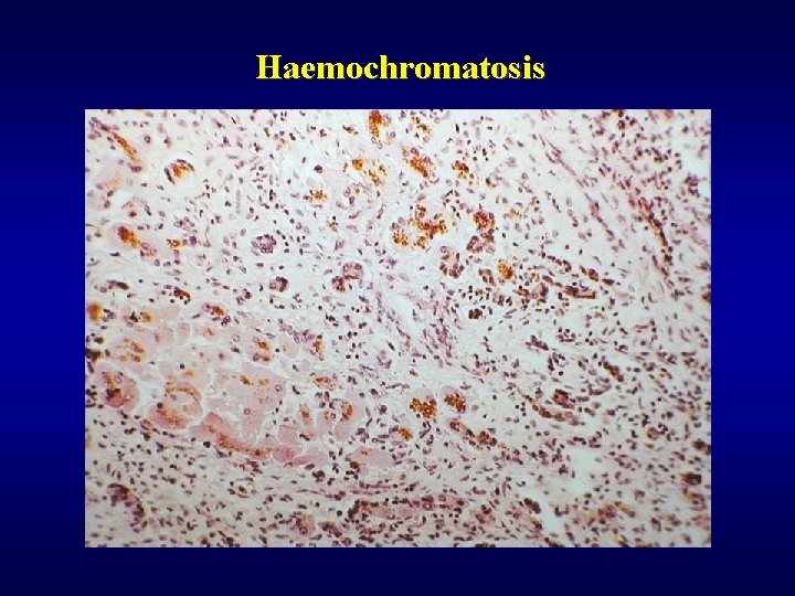 Haemochromatosis 