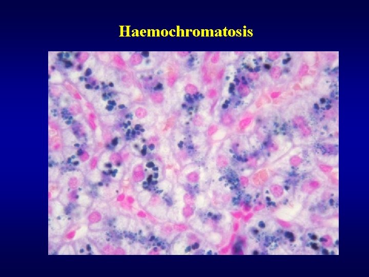 Haemochromatosis 