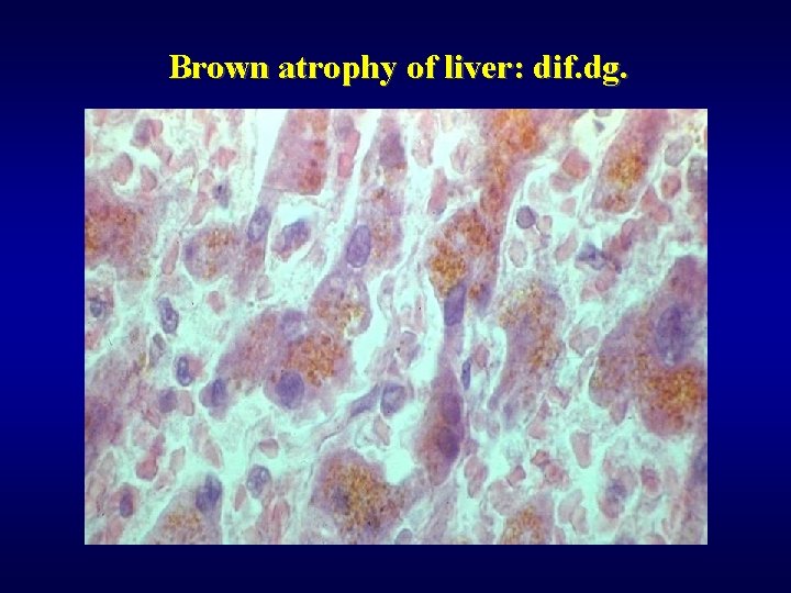 Brown atrophy of liver: dif. dg. 