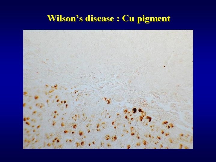 Wilson’s disease : Cu pigment 