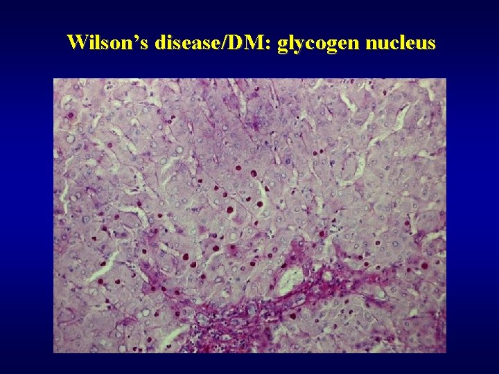 Wilson’s disease/DM: glycogen nucleus 