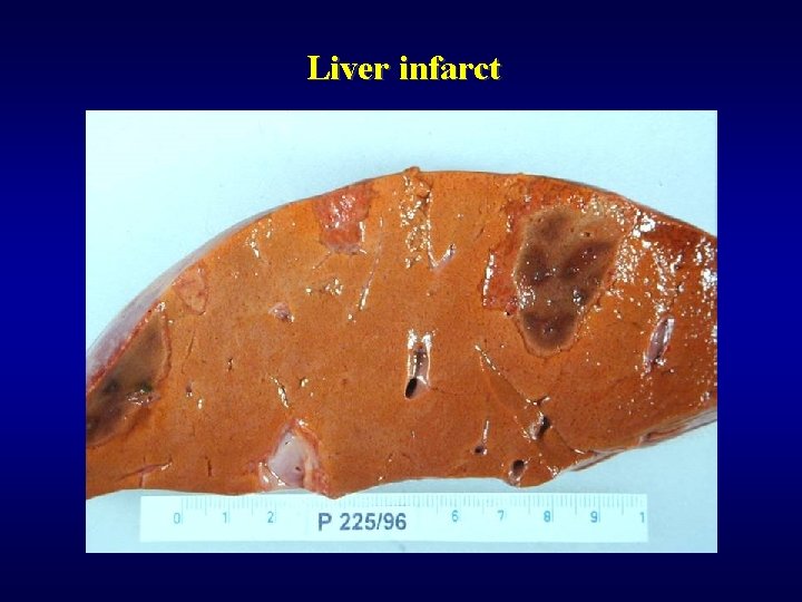 Liver infarct 