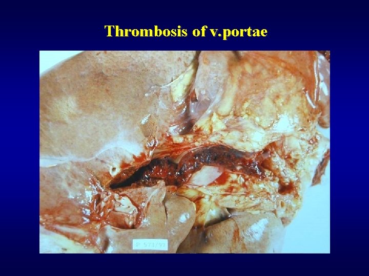 Thrombosis of v. portae 