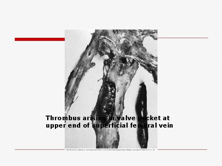 Thrombus arising in valve pocket at upper end of superficial femoral vein Thrombus arising in valve pocket at upper end of superficial femoral vein