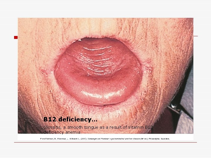 B 12 deficiency… Glossitis, a smooth tongue as a result of vitamin B 12 B 12 deficiency… Glossitis, a smooth tongue as a result of vitamin B 12