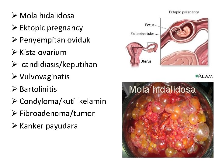 Ø Mola hidalidosa Ø Ektopic pregnancy Ø Penyempitan oviduk Ø Kista ovarium Ø candidiasis/keputihan