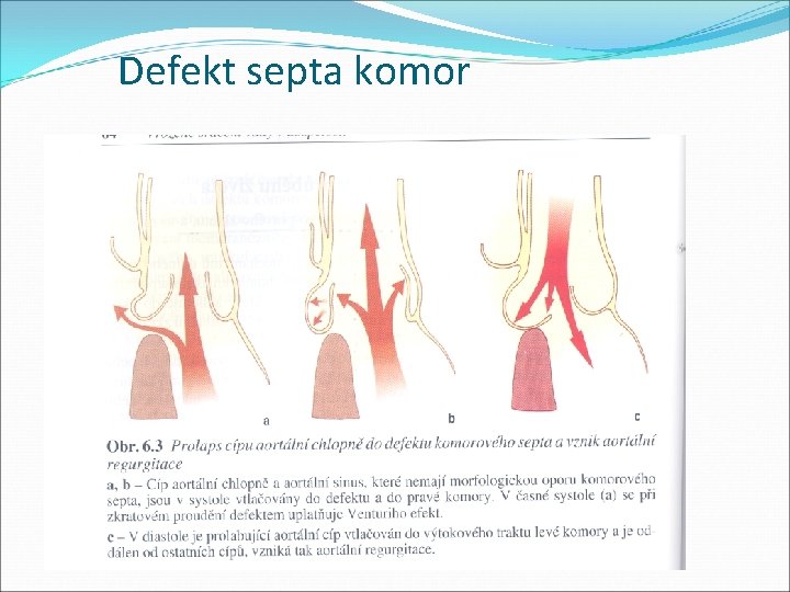 Defekt septa komor 