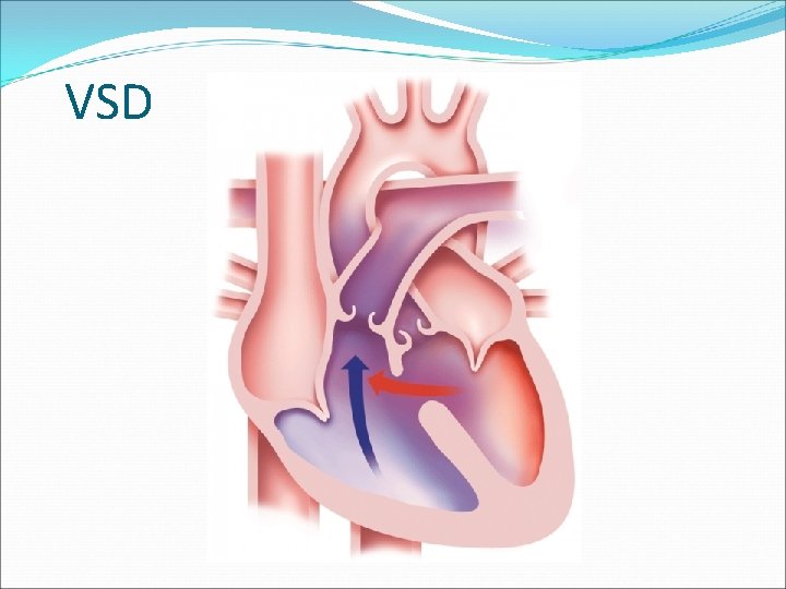 VSD 
