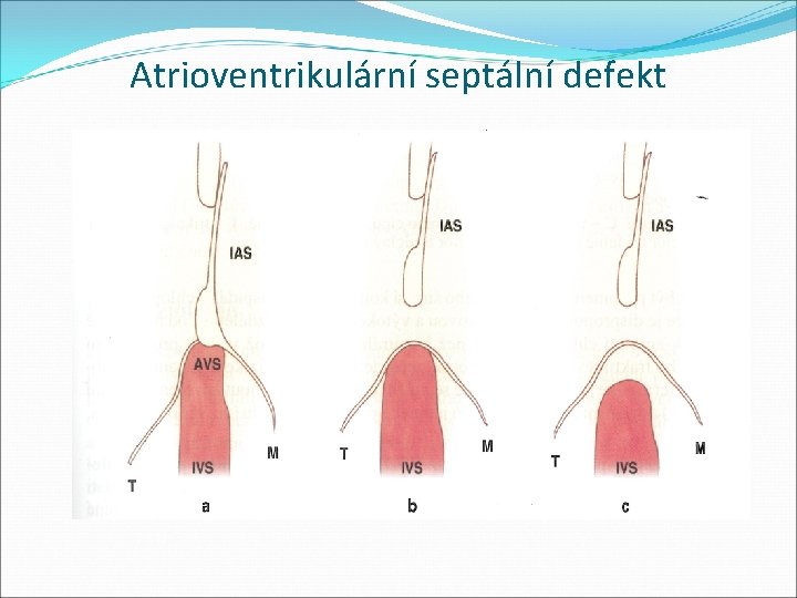 Atrioventrikulární septální defekt 