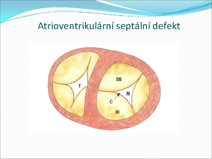 Atrioventrikulární septální defekt 
