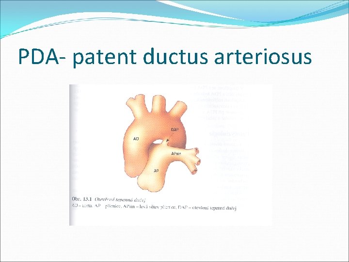 PDA- patent ductus arteriosus 