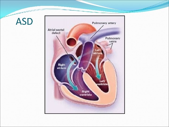 ASD 