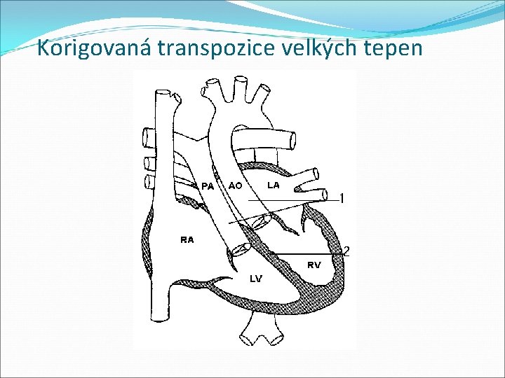 Korigovaná transpozice velkých tepen 