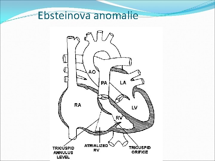 Ebsteinova anomalie 