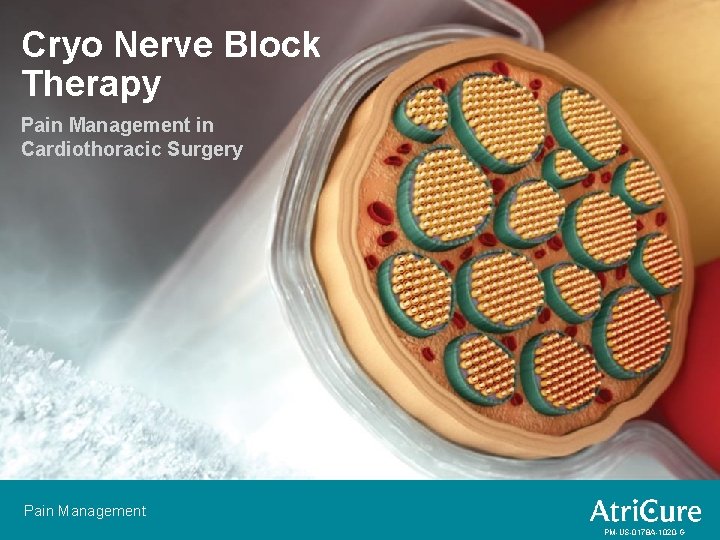 Cryo Nerve Block Therapy Pain Management in Cardiothoracic Surgery Pain Management PM-US-0178 A-1020 -G