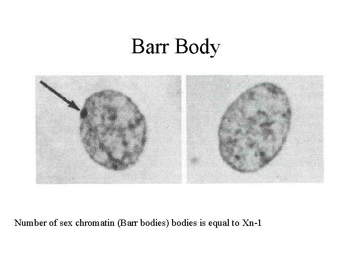 Barr Body Number of sex chromatin (Barr bodies) bodies is equal to Xn-1 