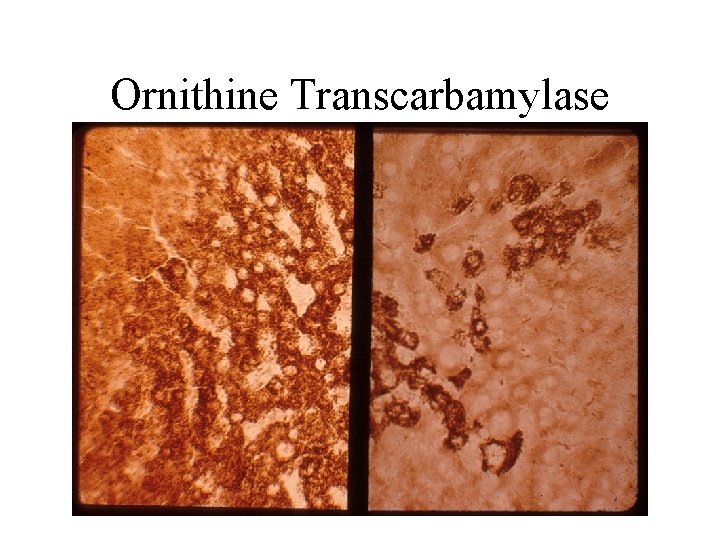 Ornithine Transcarbamylase 