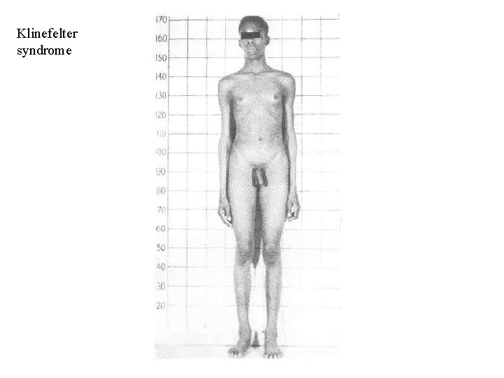 Klinefelter syndrome 