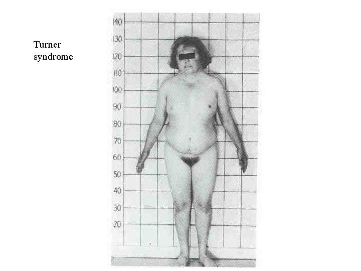 Turner syndrome 
