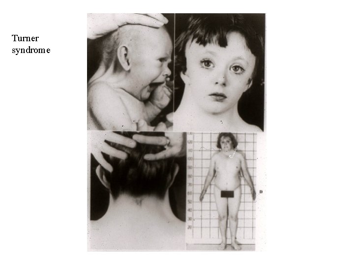 Turner syndrome 
