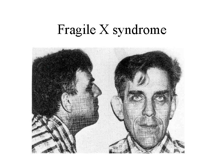 Fragile X syndrome 