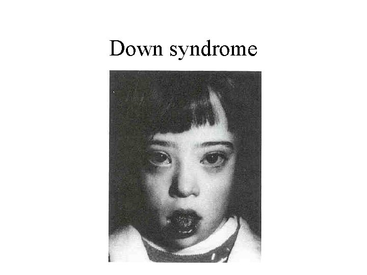 Down syndrome 