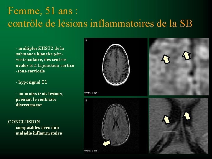 Femme, 51 ans : contrôle de lésions inflammatoires de la SB - multiples ZHST