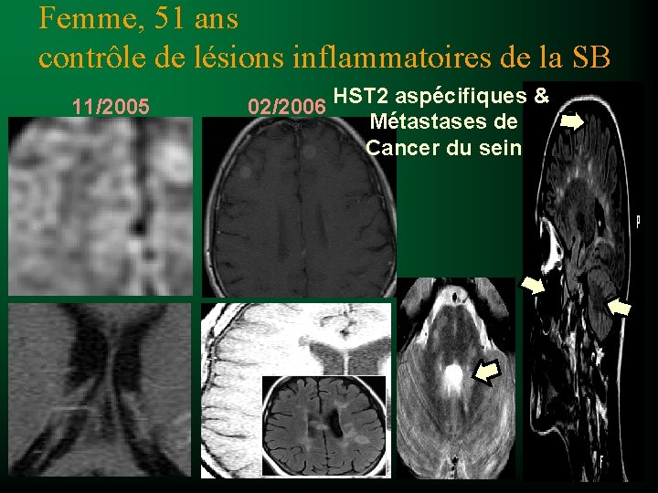 Femme, 51 ans contrôle de lésions inflammatoires de la SB 11/2005 02/2006 HST 2