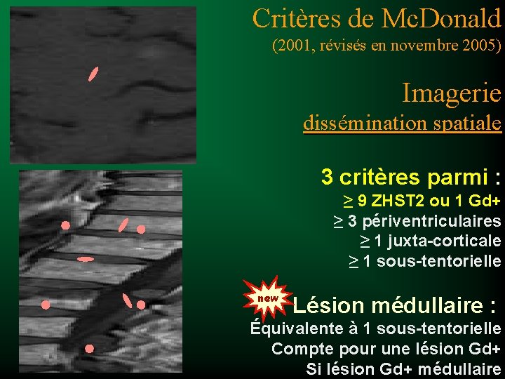 Critères de Mc. Donald (2001, révisés en novembre 2005) Imagerie dissémination spatiale 3 critères