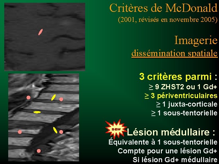 Critères de Mc. Donald (2001, révisés en novembre 2005) Imagerie dissémination spatiale 3 critères