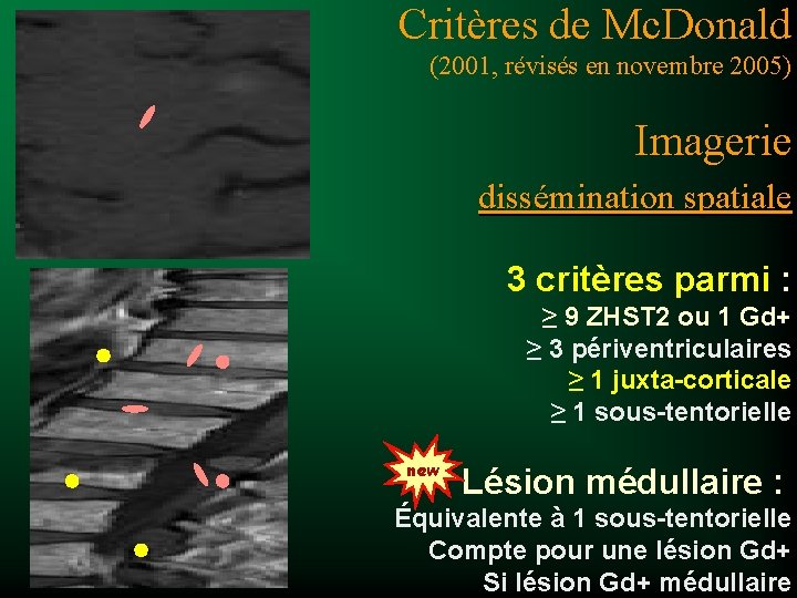 Critères de Mc. Donald (2001, révisés en novembre 2005) Imagerie dissémination spatiale 3 critères