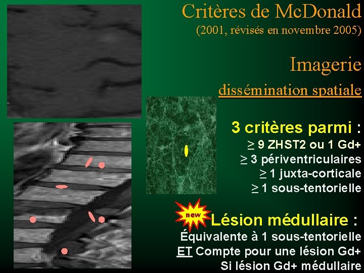 Critères de Mc. Donald (2001, révisés en novembre 2005) Imagerie dissémination spatiale 3 critères