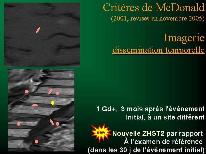 Critères de Mc. Donald (2001, révisés en novembre 2005) Imagerie dissémination temporelle 1 Gd+,