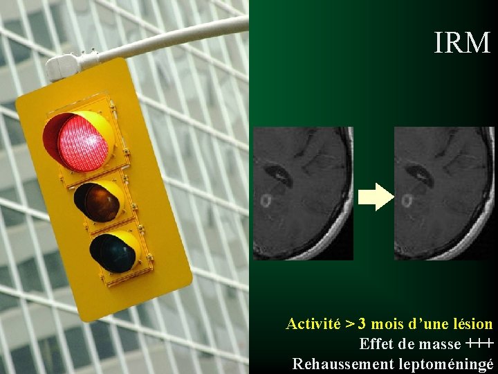 IRM Activité > 3 mois d’une lésion Effet de masse +++ Rehaussement leptoméningé 