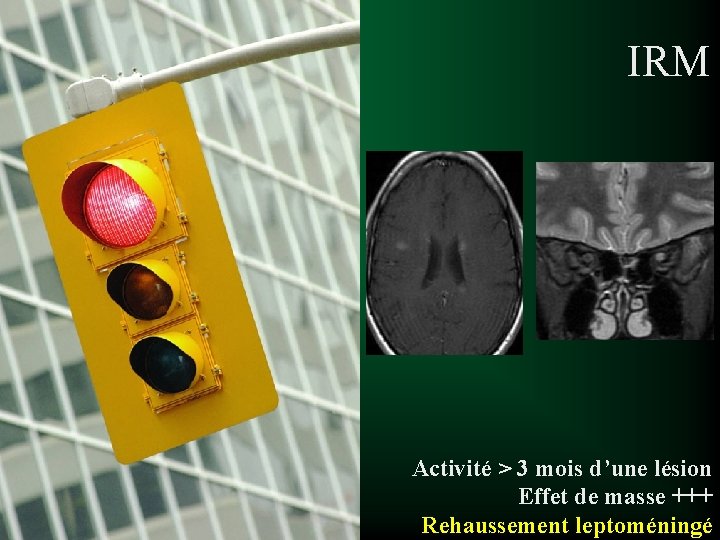 IRM Activité > 3 mois d’une lésion Effet de masse +++ Rehaussement leptoméningé 