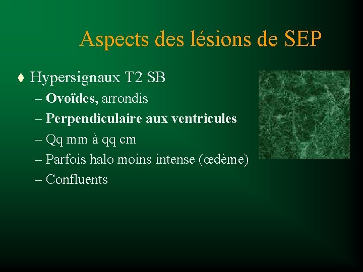 Aspects des lésions de SEP t Hypersignaux T 2 SB – Ovoïdes, arrondis –