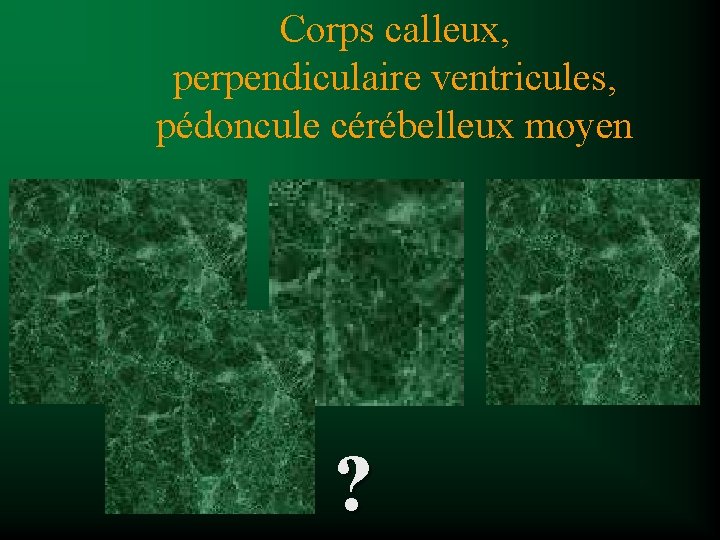 Corps calleux, perpendiculaire ventricules, pédoncule cérébelleux moyen ? 
