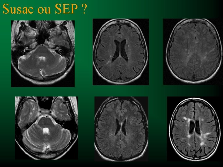 Susac ou SEP ? 