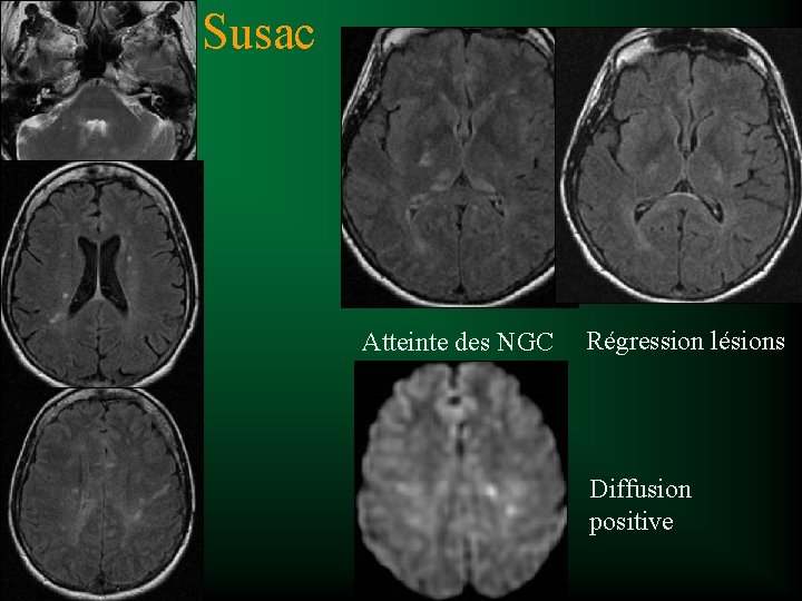 Susac Atteinte des NGC Régression lésions Diffusion positive 