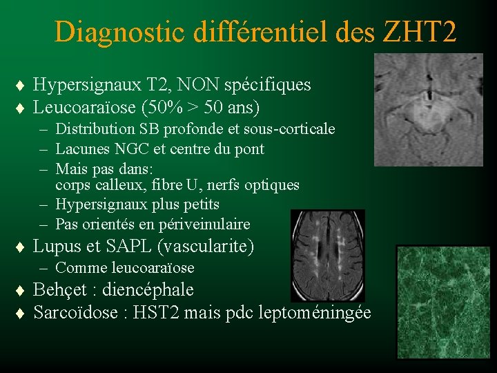 Diagnostic différentiel des ZHT 2 t t Hypersignaux T 2, NON spécifiques Leucoaraïose (50%