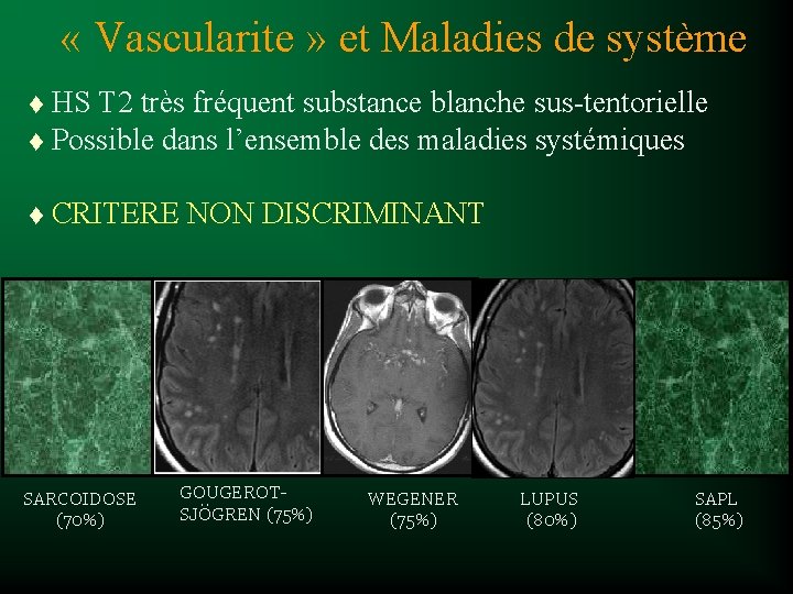  « Vascularite » et Maladies de système HS T 2 très fréquent substance