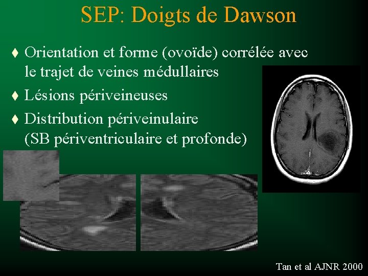 SEP: Doigts de Dawson t t t Orientation et forme (ovoïde) corrélée avec le