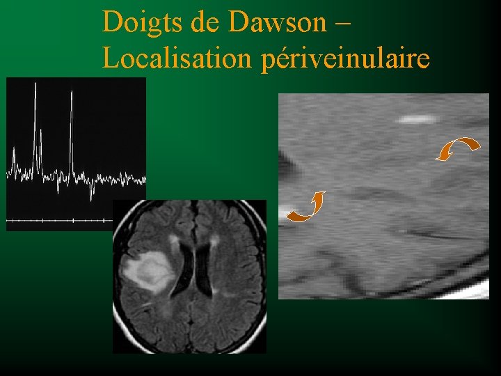 Doigts de Dawson – Localisation périveinulaire 