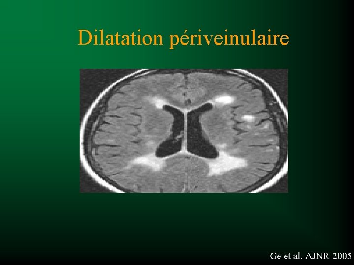 Dilatation périveinulaire Ge et al. AJNR 2005 