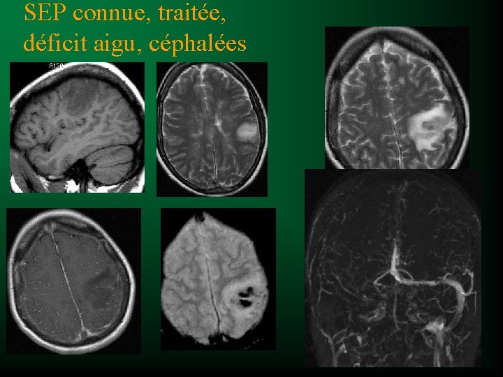 SEP connue, traitée, déficit aigu, céphalées 
