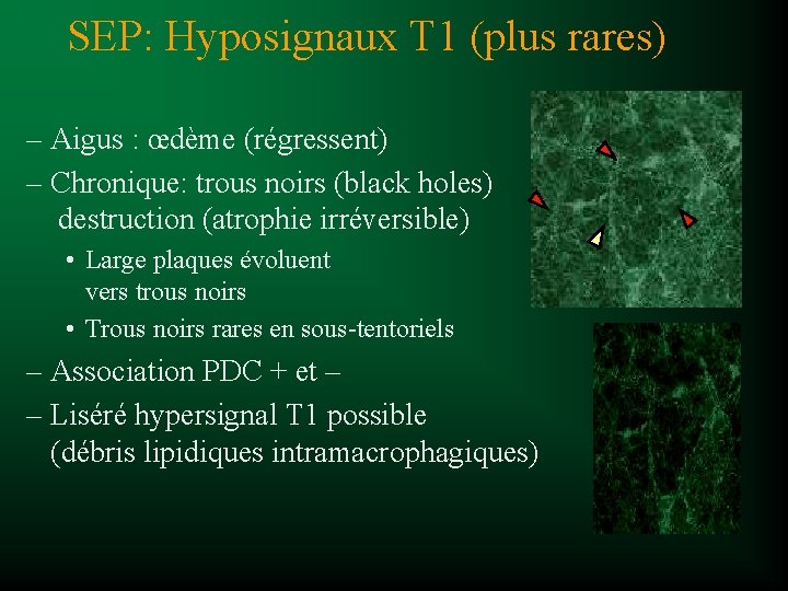 SEP: Hyposignaux T 1 (plus rares) – Aigus : œdème (régressent) – Chronique: trous