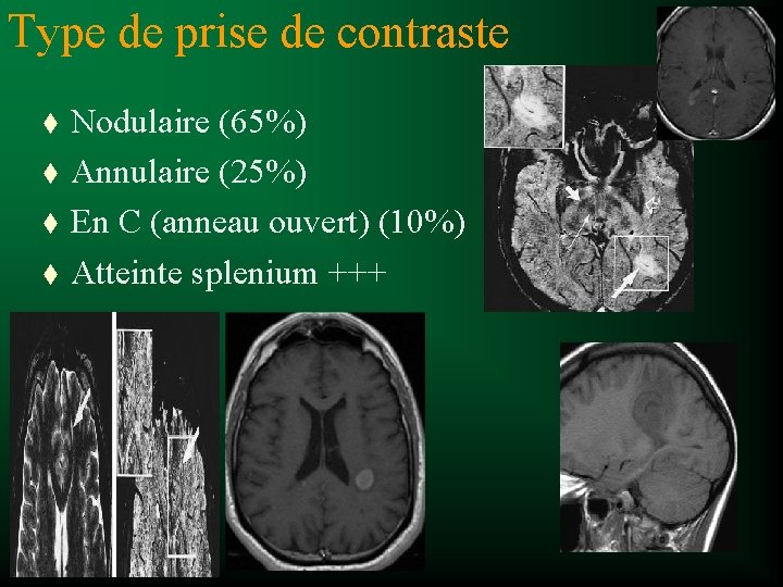 Type de prise de contraste t t Nodulaire (65%) Annulaire (25%) En C (anneau