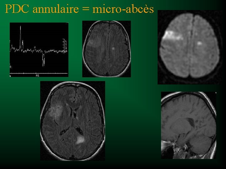 PDC annulaire = micro-abcès 